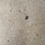 Primer nevarnega kožnega raka