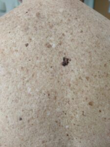 Primer nevarnega kožnega raka